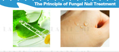 Fungal Nail Treatment Essence Nail And Foot Fungus Removal Feet Care Gel