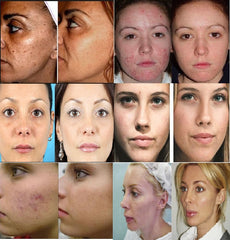 Ultrasonic DEEP CLEANING PORES WITH SPATULA