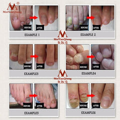 Fungal Nail Treatment