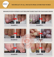 Fungal Nail Treatment