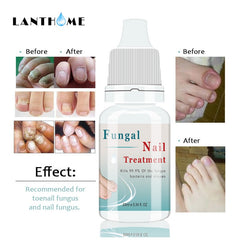 Fungal Nail Treatment Essence Nail And Foot Fungus Removal Feet Care Gel