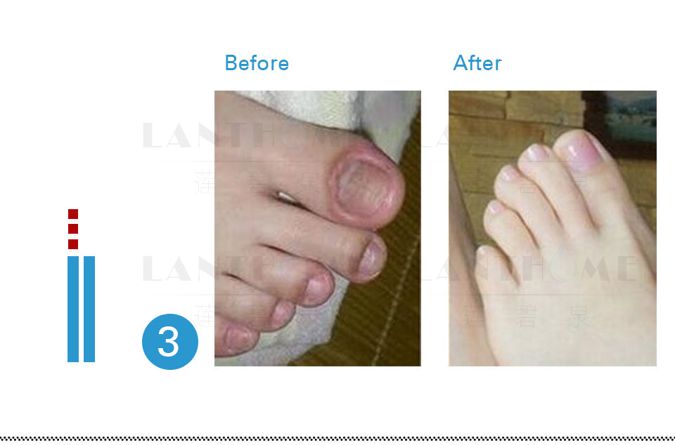 Mja 2pcs Fungal Nail Treatment Serum Onychomycosis Paronychia Anti-fungal  Nail Infection Herbal Toe Fungus Foot Repair Essence Care | Fruugo NO