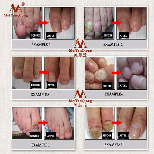 Fungal Nail Treatment