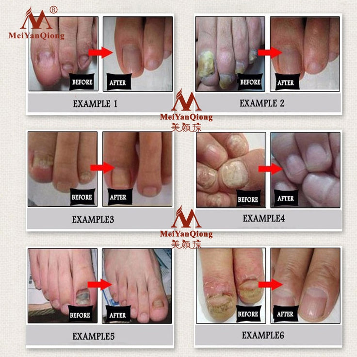 Fungal Nail Treatment