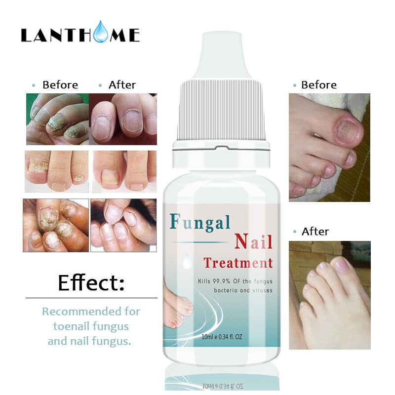 Nail Fungal Treatment Essence Nail Foot Toe Nail Fungus Removal Gel Anti  Infection Paronychia Onychomycosis Foot Care Products - AliExpress